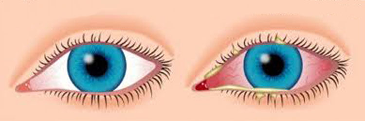 Алергічні захворювання очей. Як проявляються алергічні захворювання очей